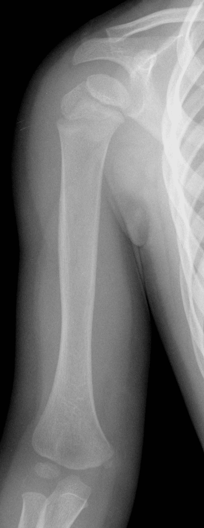 1. AP humerus