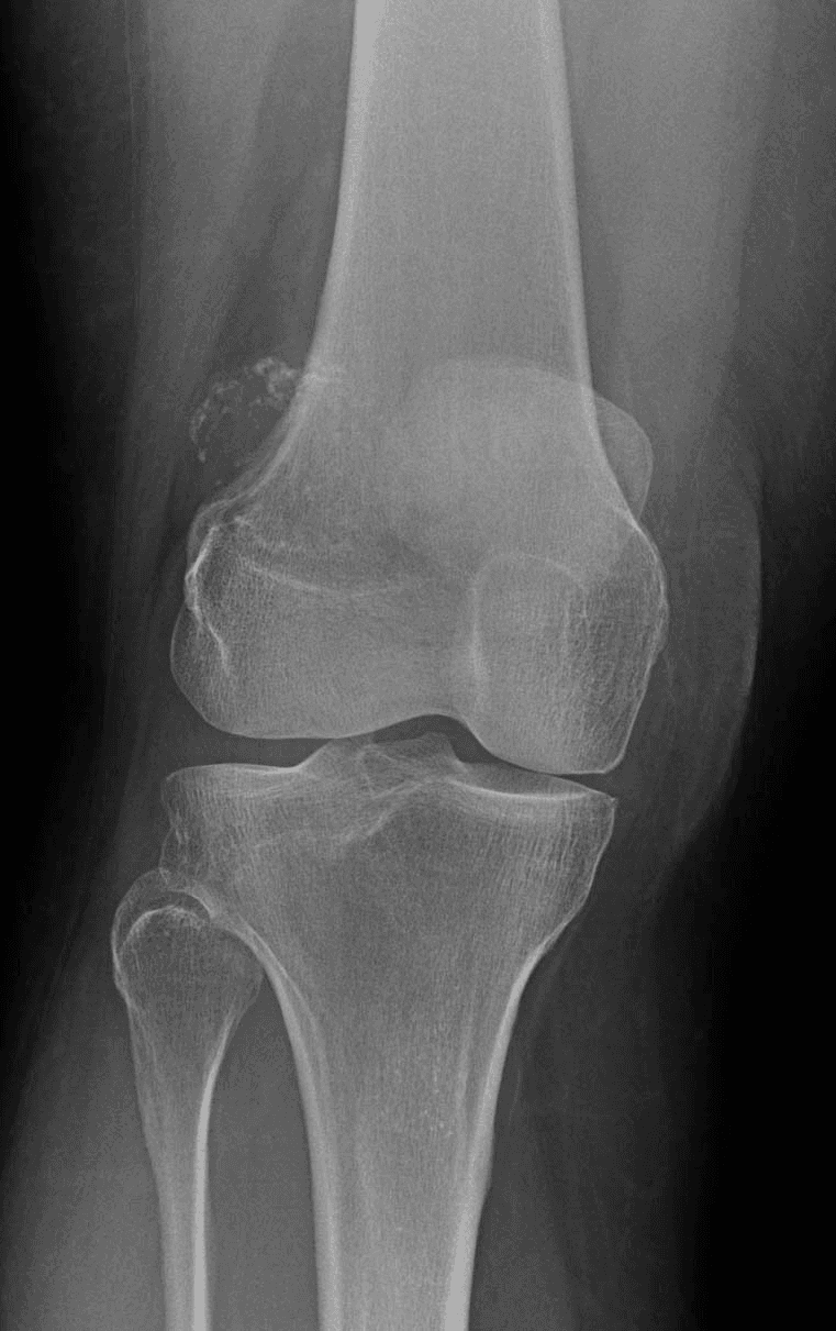 1. AP knee