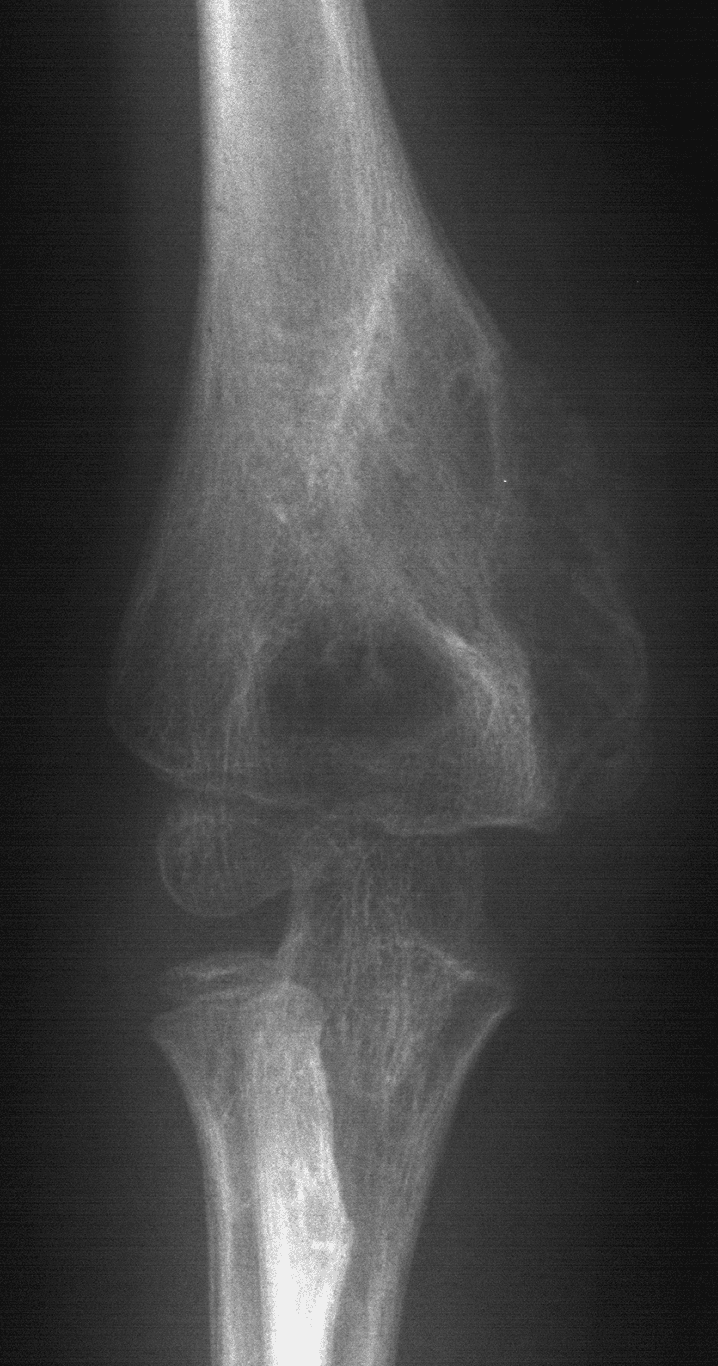 1. AP elbow