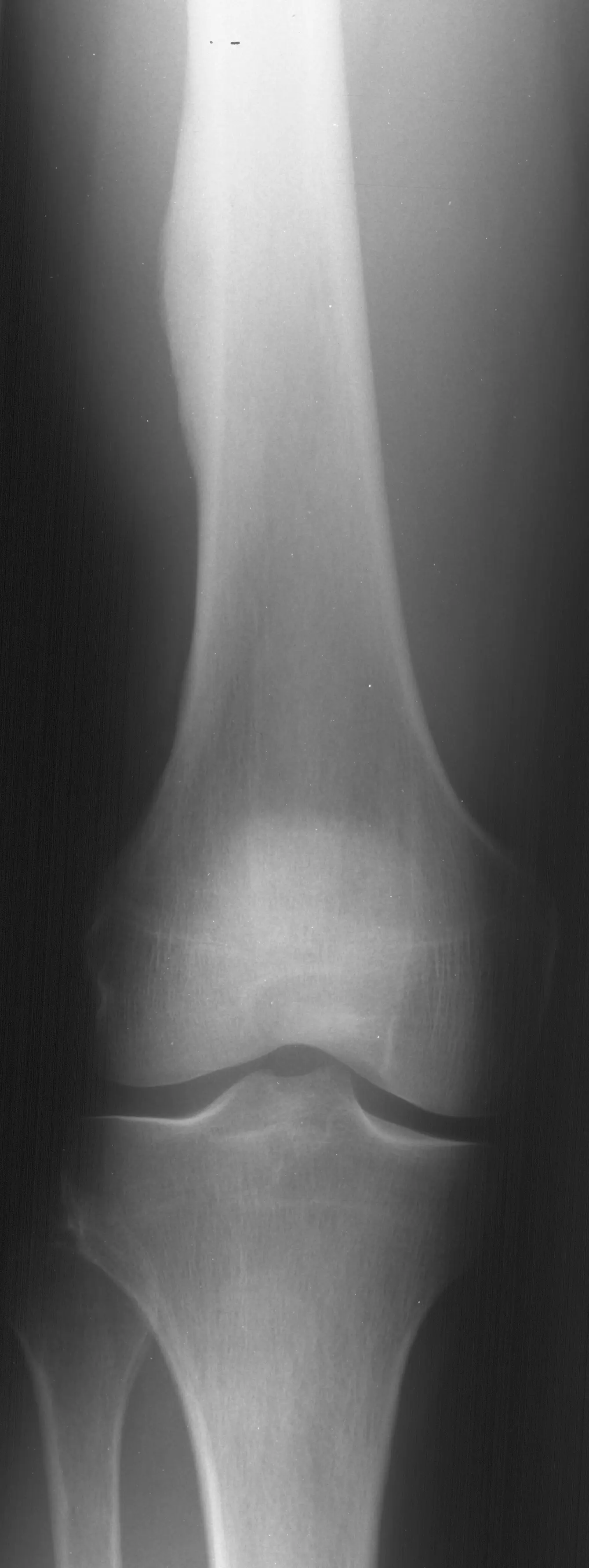 1. AP knee