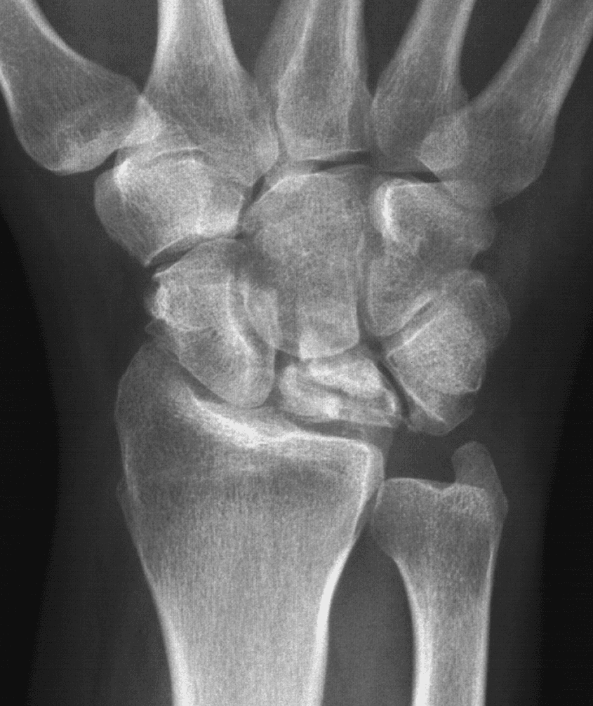 1. PA wrist