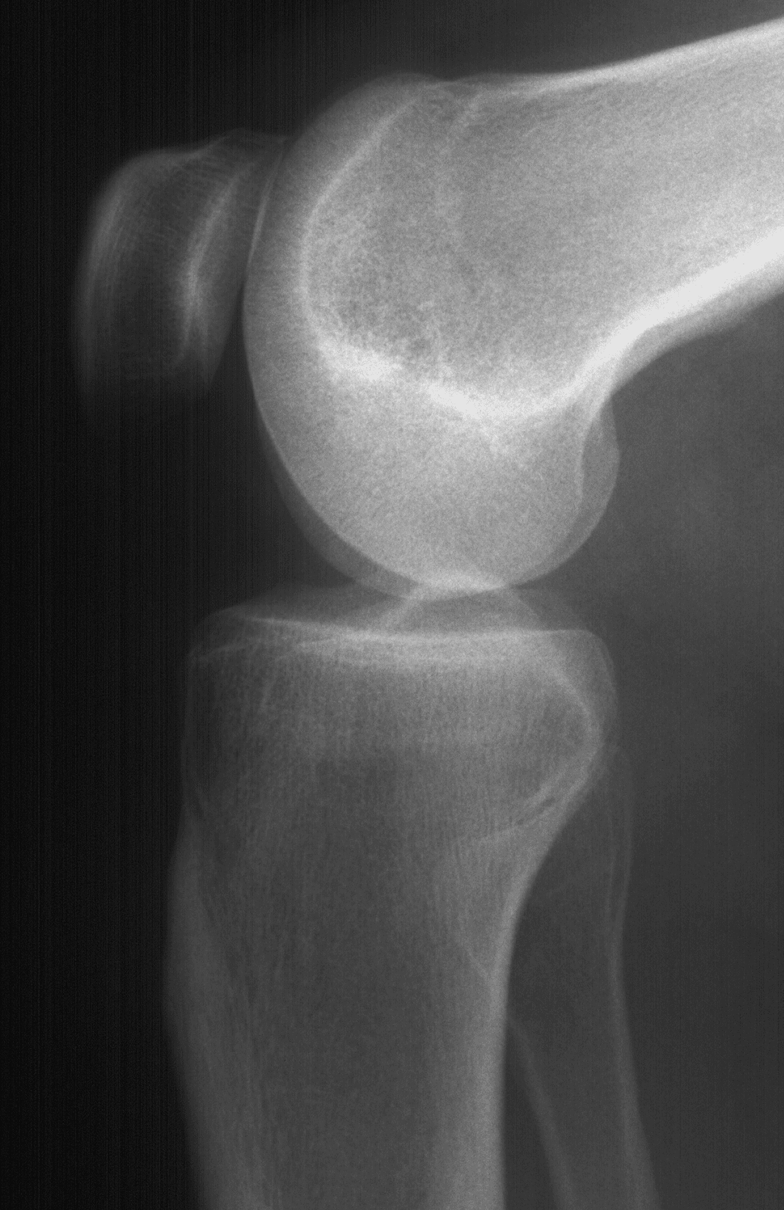 1. Lateral knee