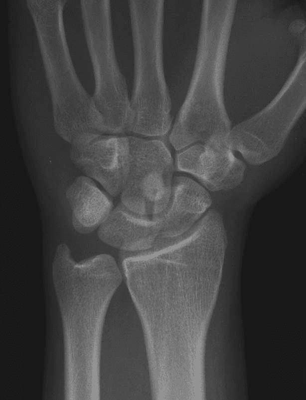 1. PA wrist