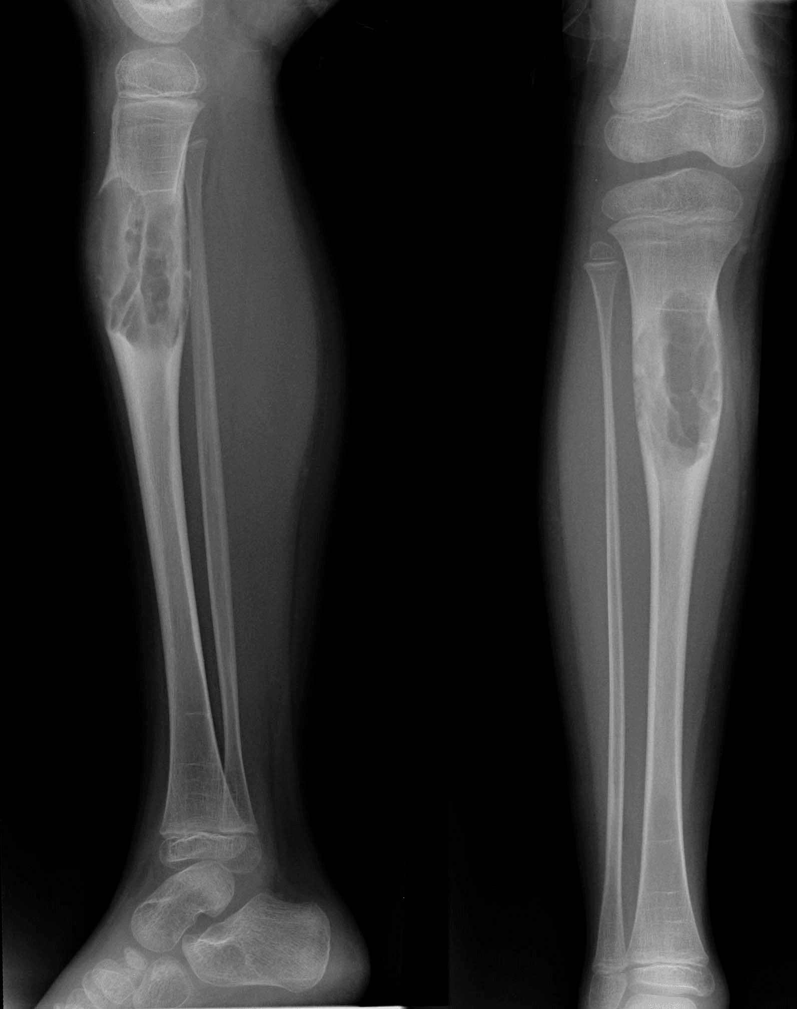 1. AP & lateral tibia
